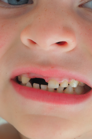 Knocked-Out Tooth