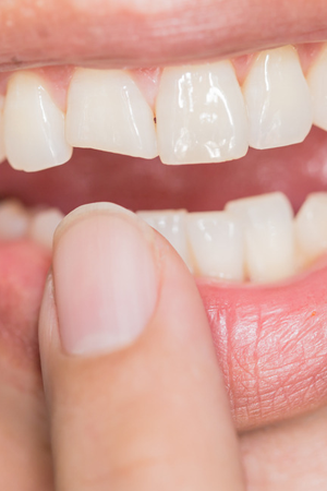 Broken or Cracked Teeth